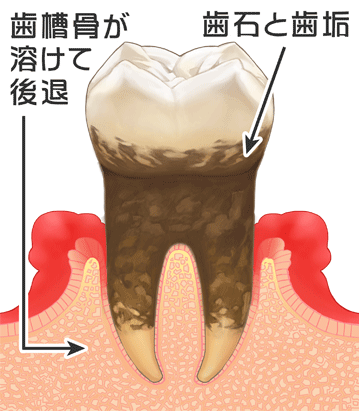 歯周病の進行（臼歯）　P3